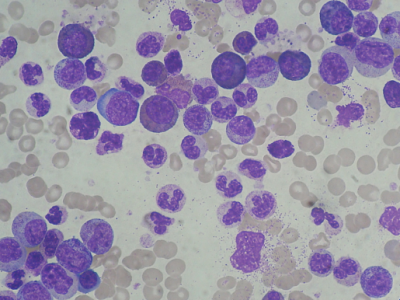 Chronic Myeloid Leukemia Smear