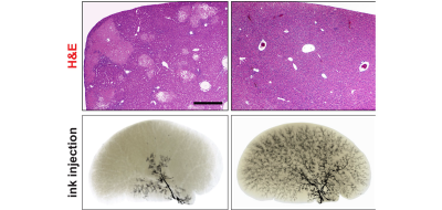 Treatment with anti-Poglut1 ASO significantly improves liver damage in a mouse model of Alagille syndrome