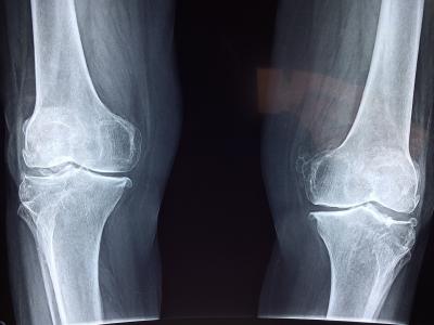 Xray of knee