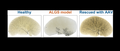 Shown are biliary tree ink injection images from the left liver lobes of 30-day-old mice. Note the improvement in the density and peripheral extension of the biliary tree in Alagille syndrome (ALGS) model upon AAV-mediated gene therapy. From Fox et al, Gastroenterology.