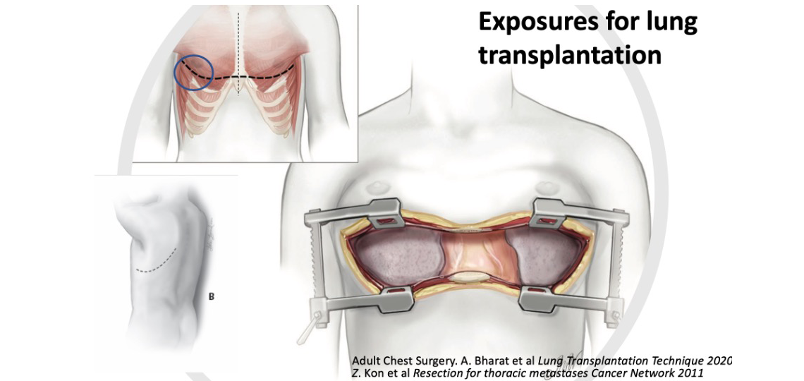 exposures for lung transplantation