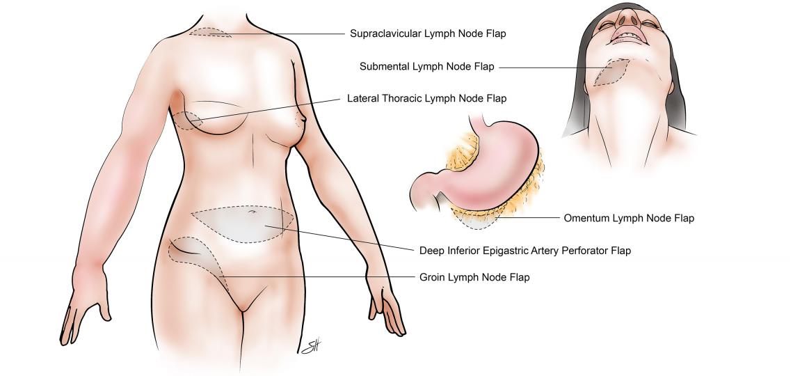 Lymph node transfer sites