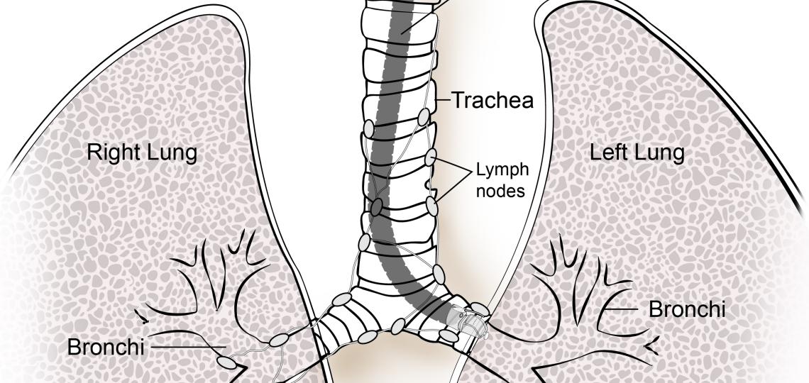 Illustration depicting the Endobronchial Ultrasound procedure. A small ultrasound probe is inserted through the trachea to take images of the right and left lung.