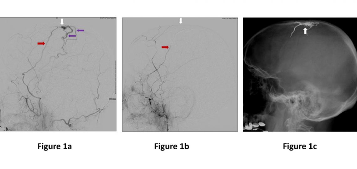 Figure 1. Dural Arteriovenous Fistulas
