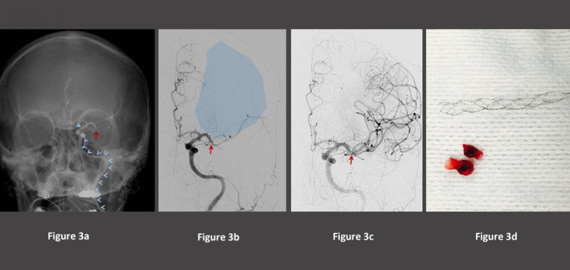 Figure 3. Stroke imaging