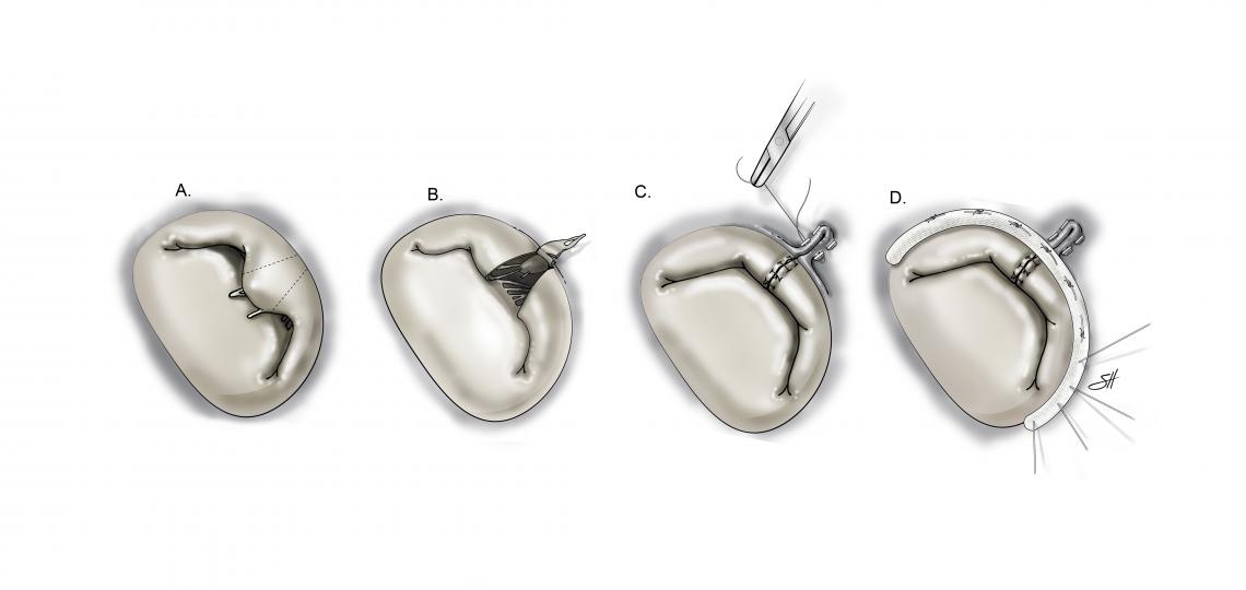 Triangular, posterior mitral valve leaflet repair.