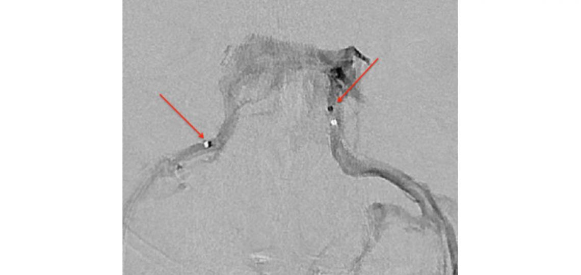 Cerebral venogram outlining bilateral cavernous sinuses and inferior petrosal sinuses. A microcatheter (arrow) is seen in each inferior petrosal sinus.