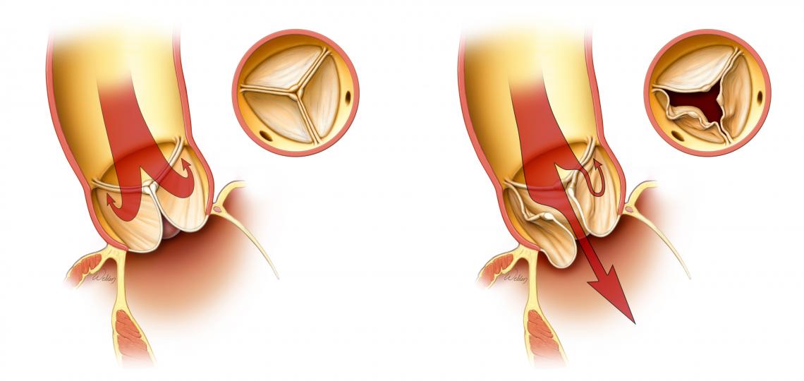A normal closed valve (left). A leaking valve - called insufficiency or regurgitation (right).
