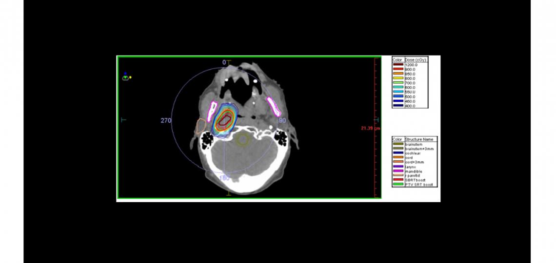 STEREOTACTIC BODY RADIOTHERAPY (SBRT) Dr. Wagner Baylor College of Medicine Houston Texas Medical Ce