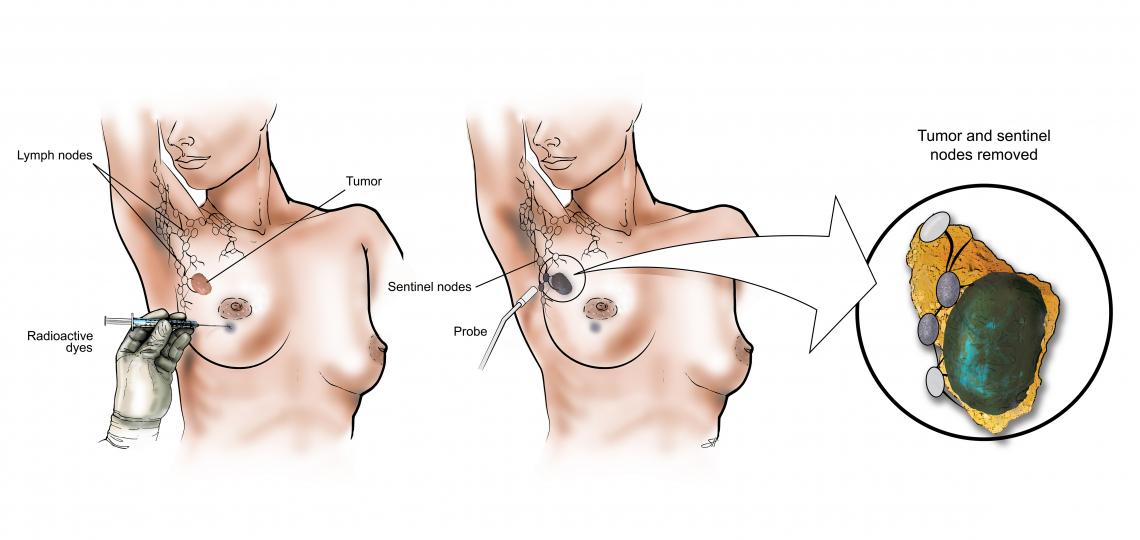 Sentinel Lymph Node Biopsy diagram