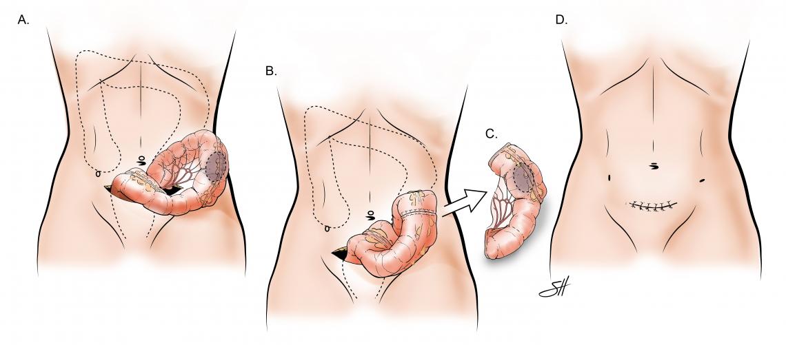 Minimally Invasive Colectomy with Standard Specimen Removal from the Abdomen. This shows the bowel to be brought out through the larger incision and the ends are hooked back up together after the bowel is resected with final incision noted. 