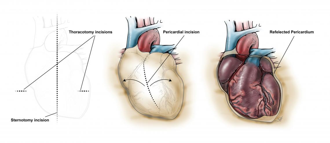Illustration of a pericardiectomy