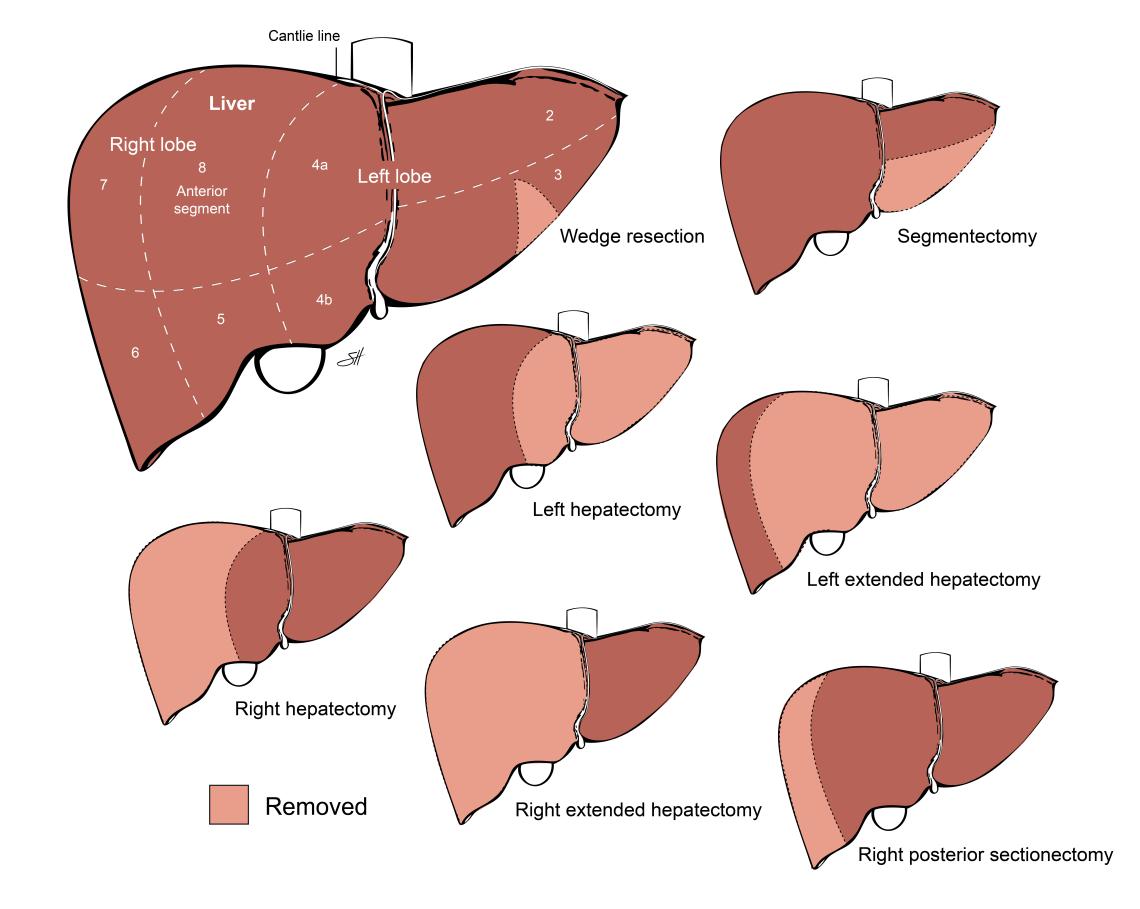Illustration of liver resection
