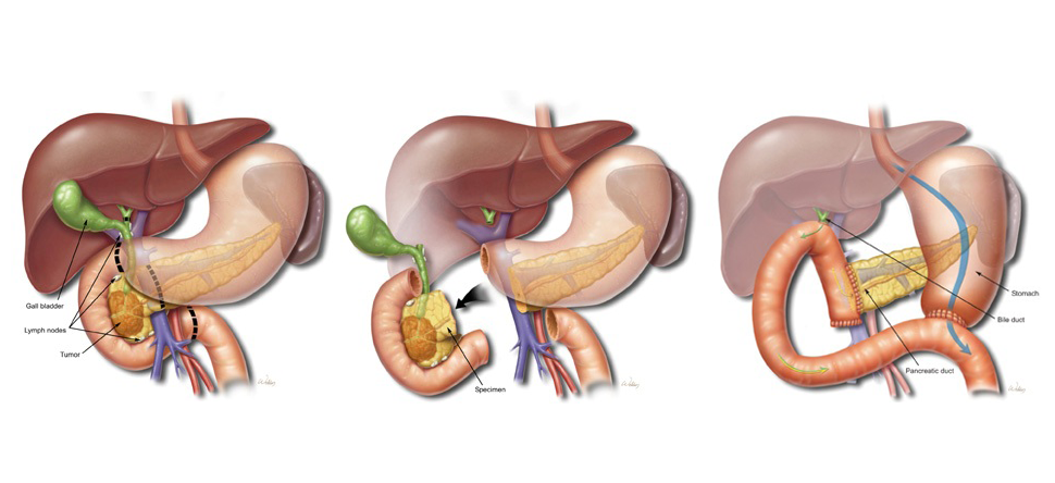 The Whipple Procedure