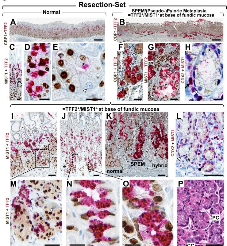 Metaplasia and Cancer