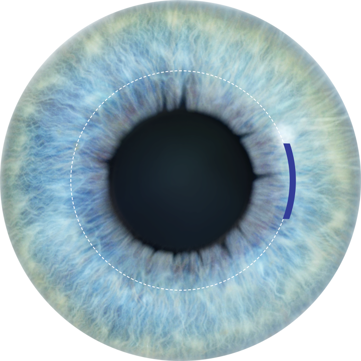 Close-up digital illustration of a human blue iris and pupil, overlaid with a dotted white circular outline and a small solid blue arc on the right side, representing the corneal incision area in a SMILE (Small Incision Lenticule Extraction) eye surgery procedure.