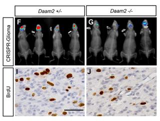 Daam2 driven degradation of VHL promotes gliomagenesis