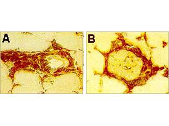 Perivascular (A) and endomysial (B) CD4 positive inflammatory cells in dermatomyositis.