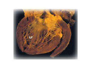 DCM Heart. Towbin, JA and Bowles, NE. The Failing Heart. Nature. 2002; 415:227-33.