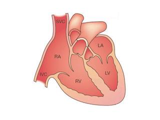 LVNC Heart. Towbin, JA and Bowles, NE. The Failing Heart. Nature. 2002; 415:227-33.