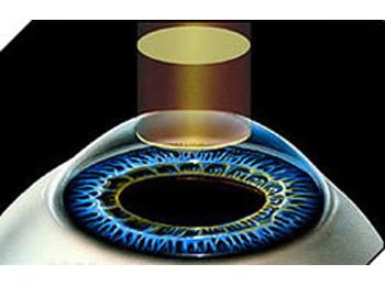Lasik - PRK (Photorefractive Keratectomy)
