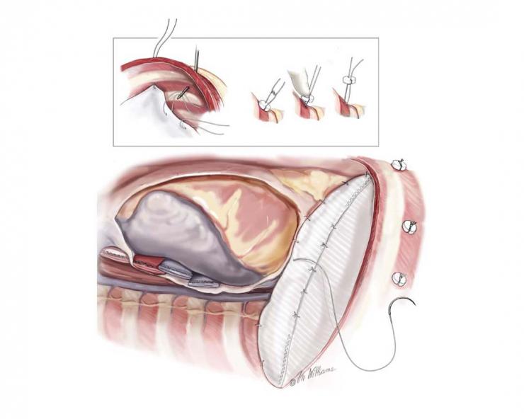 Each suture is passed through a plastic button and tied down onto button for added strength. Image courtesy McGraw-Hill Company.