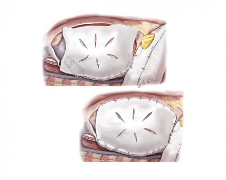 A pericardial patch is scored and sewn to the pericardial edge. Both patches are sutured to the cut edge of the pericardium and to each other. Image courtesy McGraw-Hill Company.