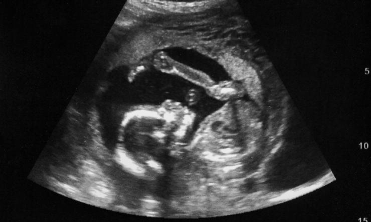 Ultrasound image