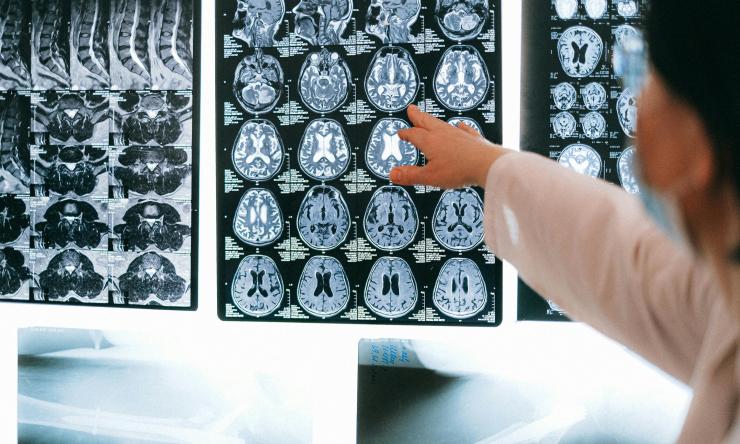 Photo of a doctor pointing to brain scans on a light box